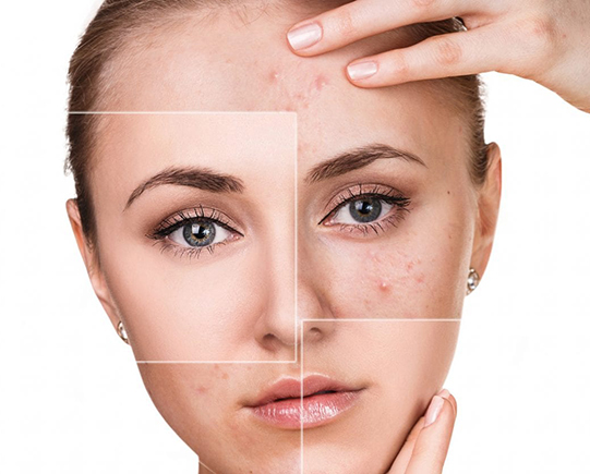 Trị Sẹo Thâm Tại Sen Beauty
